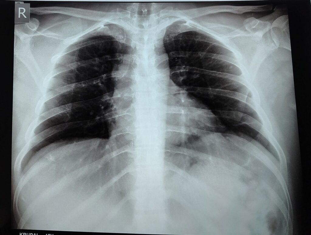 Chest X-ray image